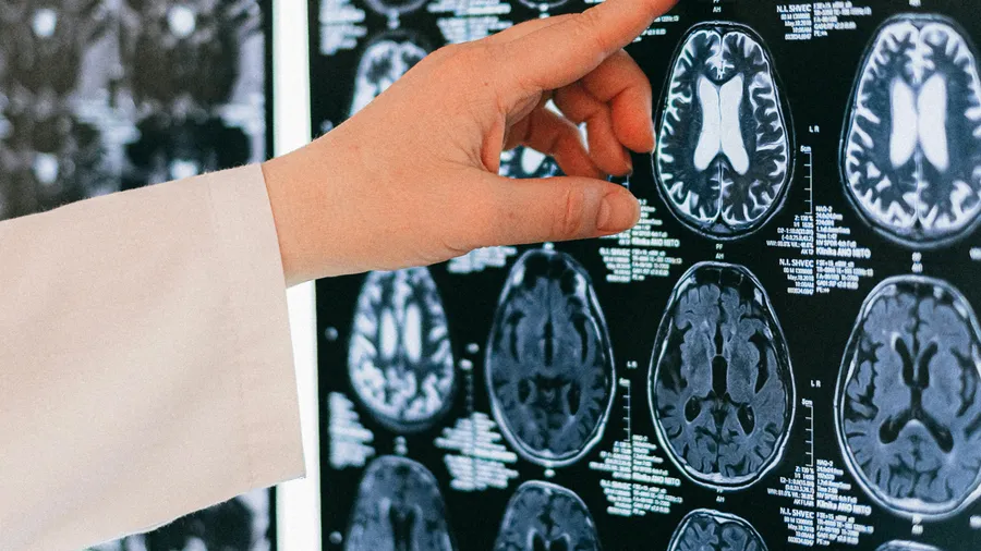 Semax: Mechanism, Evidence, and Dosing Protocols